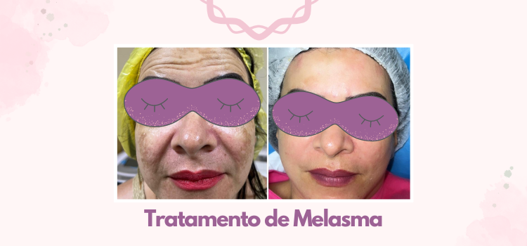 Antes e depois do tratamento de melasma