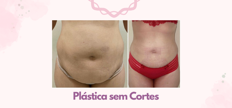 Resultado do tratamento plástica sem cortes