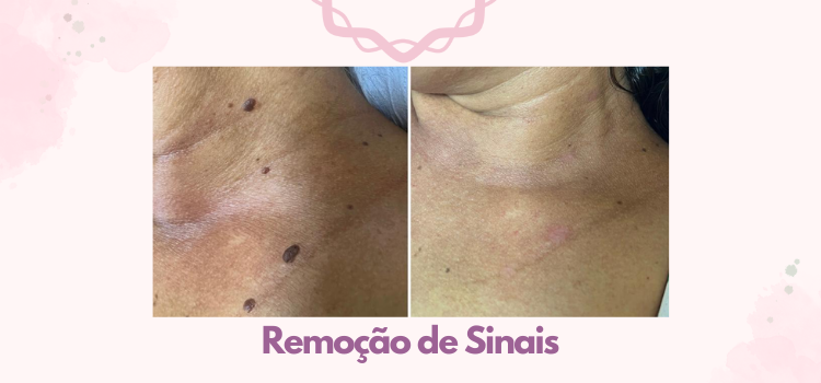 Antes e depois da remoção de sinais